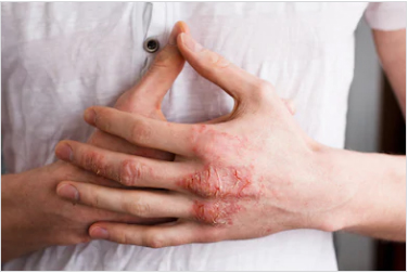 skin problems eczema and psoriasis