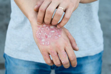 Daruhaldi powder benefits in skin problem