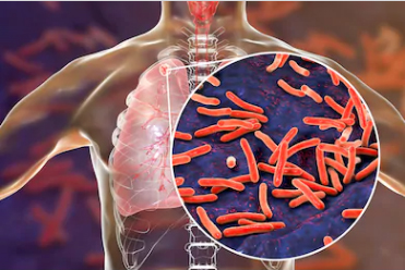 Indukanta ghrit benefits in tuberculosis